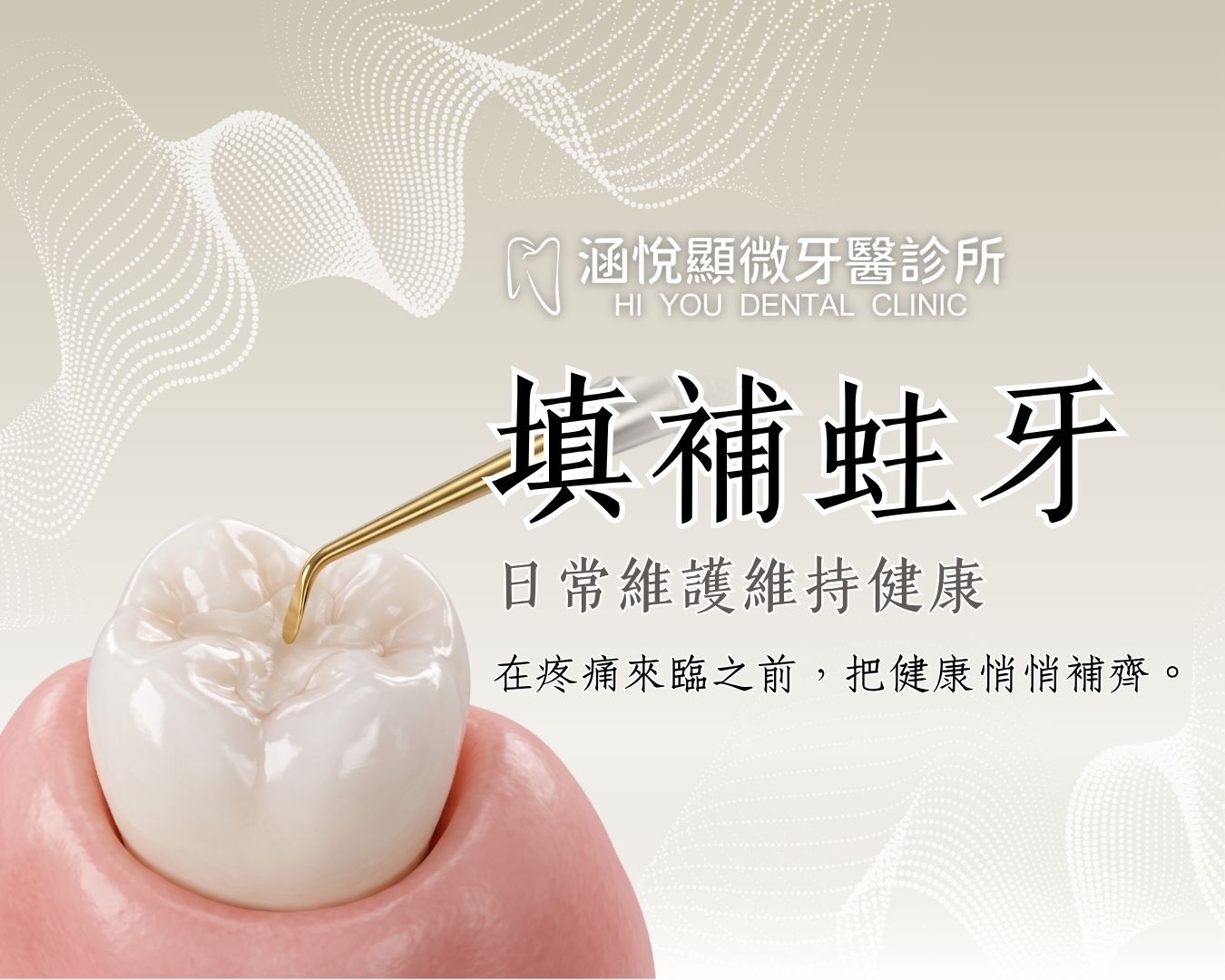 填補蛀牙